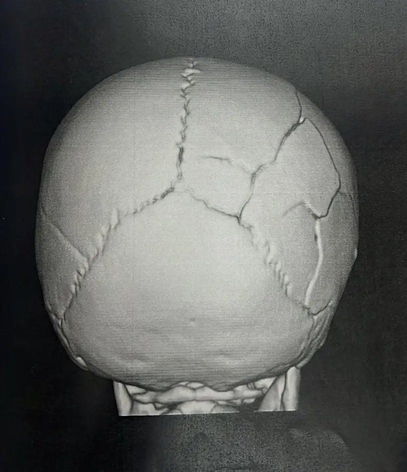 Radiografia do crânio da bebê com as fraturas feitas pelo padrasto.