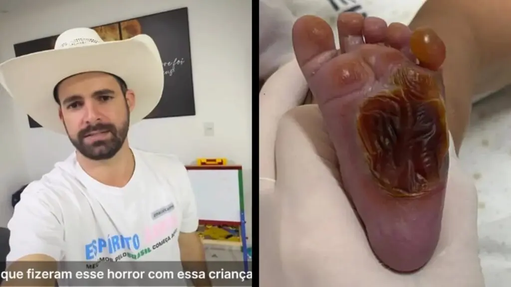 Profissionais envolvidos no caso da queimadura do bebê são afastados após ofício do deputado Muribeca