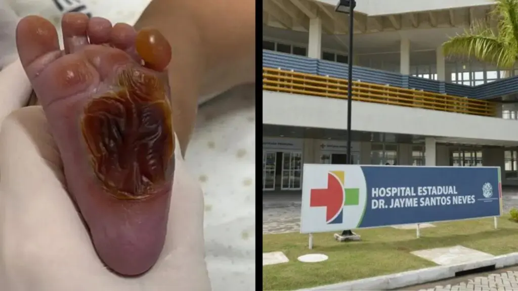 Técnica de enfermagem é demitida após incidente com queimadura em bebê na Serra