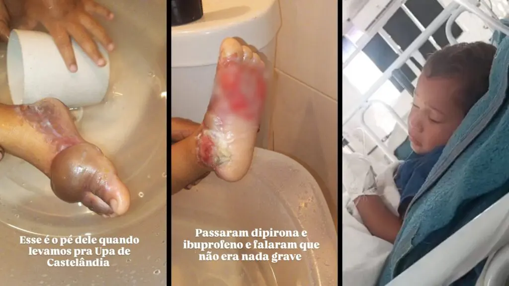 Família denuncia que criança foi liberada sem os cuidados compatíveis com a queimadura na UPA de Castelândia, na Serra.