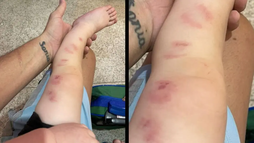 Bebê sofre múltiplas mordidas em creche municipal da Serra e pais cobram explicações Bebê sofre múltiplas mordidas em creche municipal da Serra e pais cobram explicações