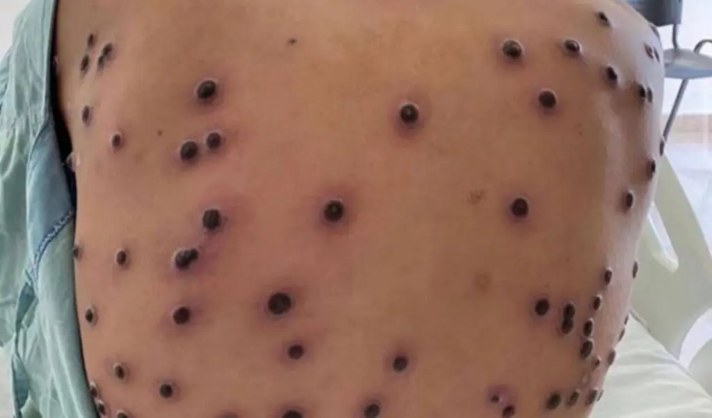 Homem com lesões na pele compatíveis com Mpox em matéria sobre 2º caso confirmado na Serra