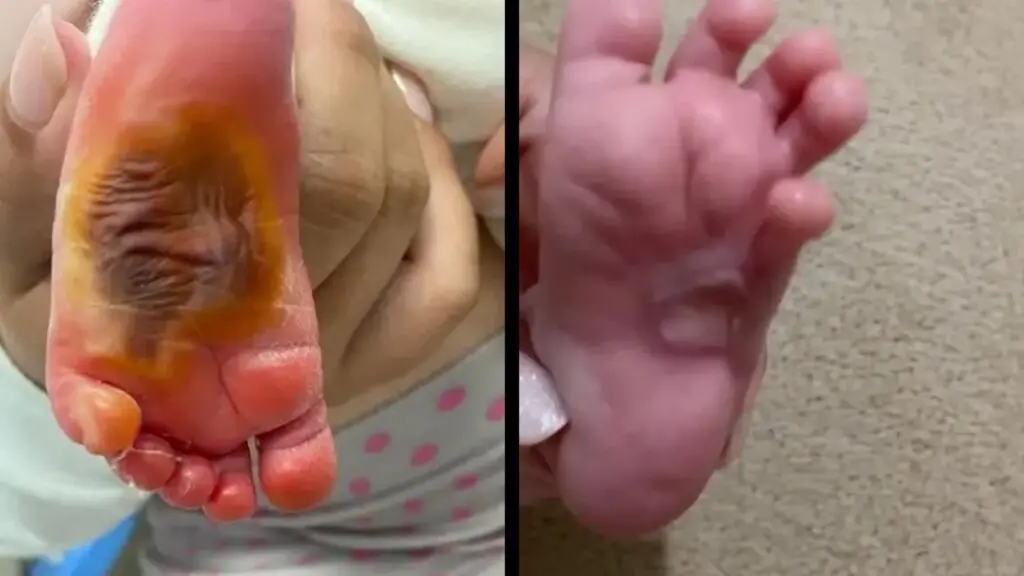 Mãe de bebê queimado em maternidade da Serra denuncia novo drama após cirurgia ser cancelada