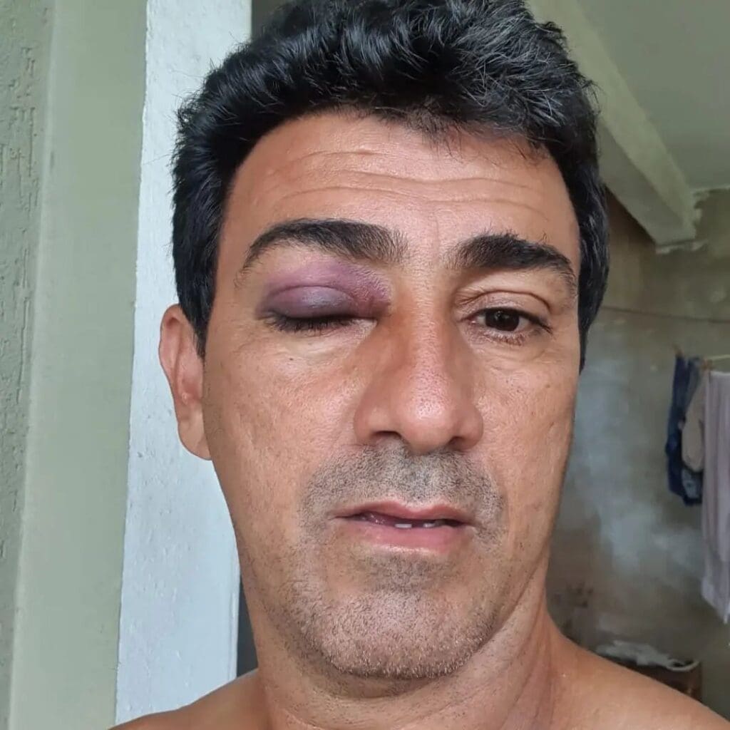 Rubens Pereira exibe olho roxo após suposta agressão na sede da Prefeitura da Serra