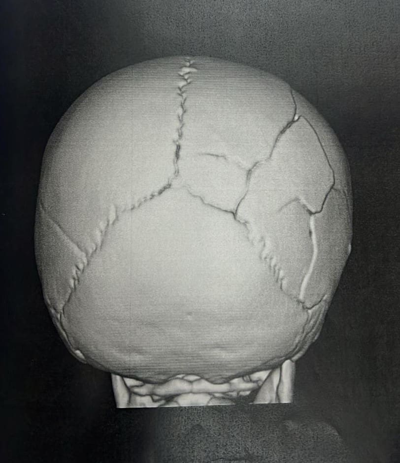 Radiografia do crânio da bebê com as fraturas feitas pelo padrasto.