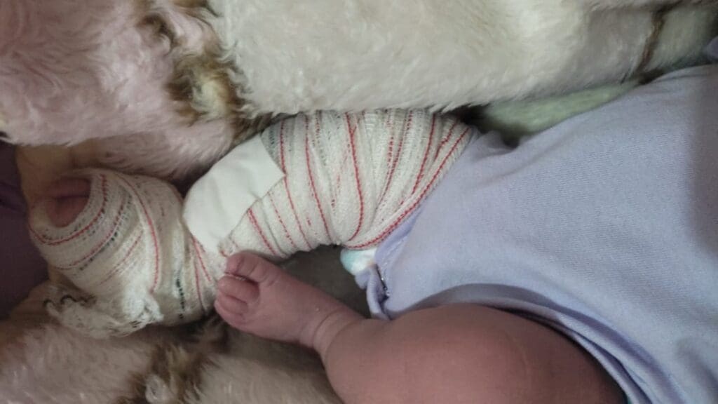 Parto complicado resulta em fratura na perna de bebê no Hospital Materno Infantil da Serra