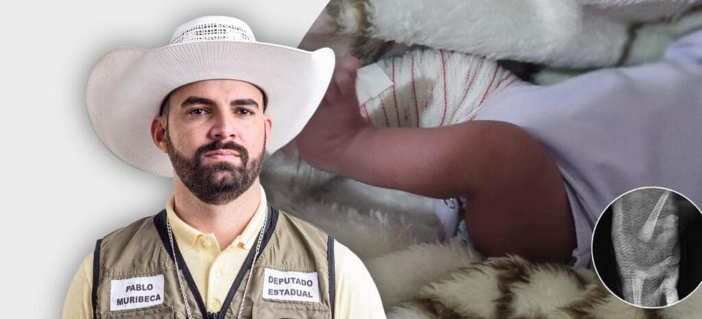 Mãe de bebê que teve a perna quebrada durante parto recorre a Pablo Muribeca por justiça Deputado Pablo Muribeca assume caso de bebê com perna quebrada no parto e promete justiça para a família