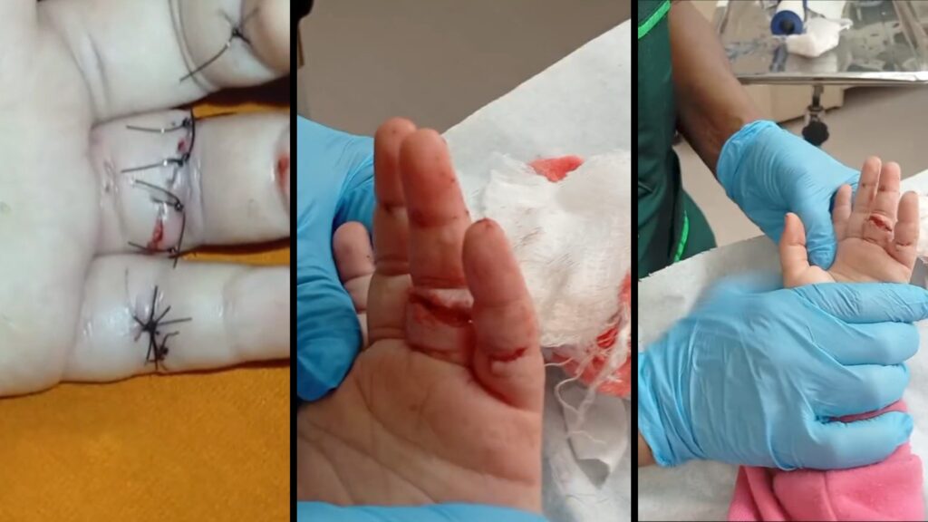 Criança de 5 anos tem cortes na mão após se acidentar com prato de vidro em creche da Serra