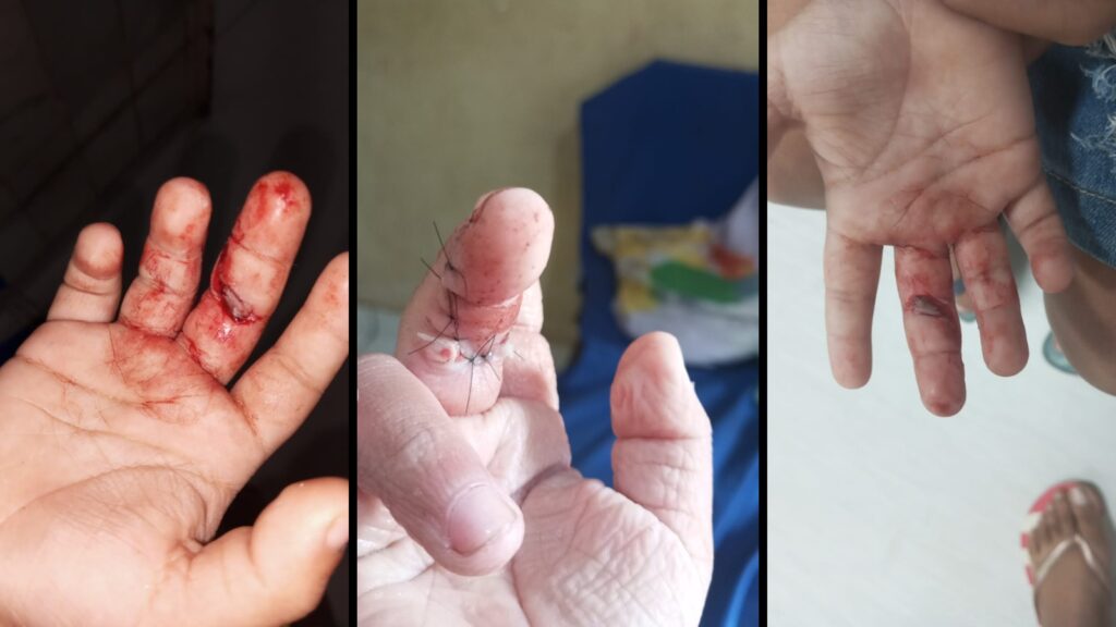 Mais uma criança teve dedo cortado por prato de vidro em creche na Serra Serra Noticiário recebe segundo caso de criança de 5 anos que se cortou com prato de vidro em creche da Serra