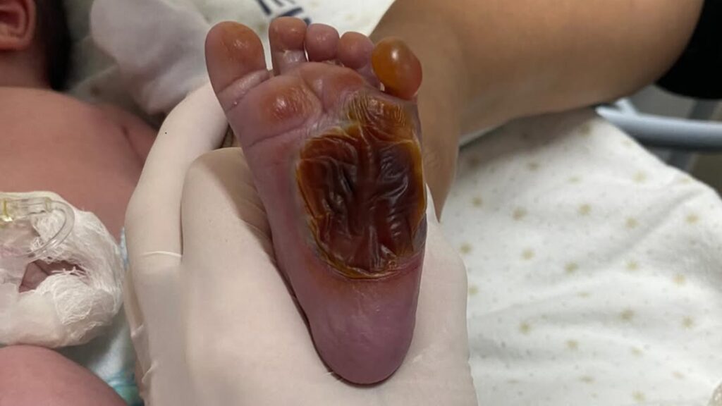 Imagem mostra o pé do bebê após queimadura sofrida dentro do Hospital Jayme Santos Neves, na Serra. Caso está sendo investigado