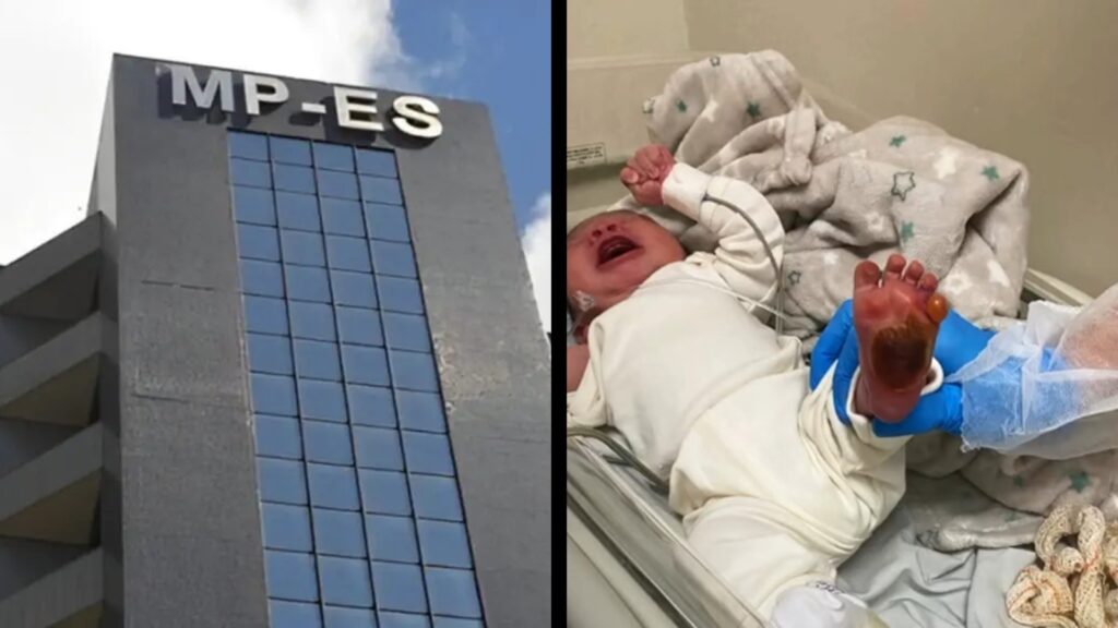 MPES abre investigação para apurar caso de bebê que teve o pé queimado no Hospital Jayme